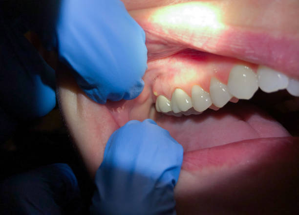 Best Emergency Wisdom Teeth Removal in White Plains, NY